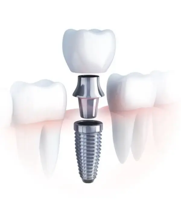 Când experiența face diferența: implantologie dentară la Centrul Medical Dr. Mihălceanu din Timișoara