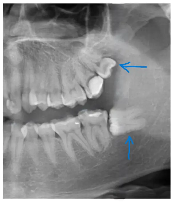 Molarii de minte: să îi păstrezi sau să îi scoți? Răspunsul expertului Dr. Mihălceanu