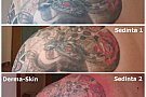Indepartarea tatuajelor cu laser la Timisoara