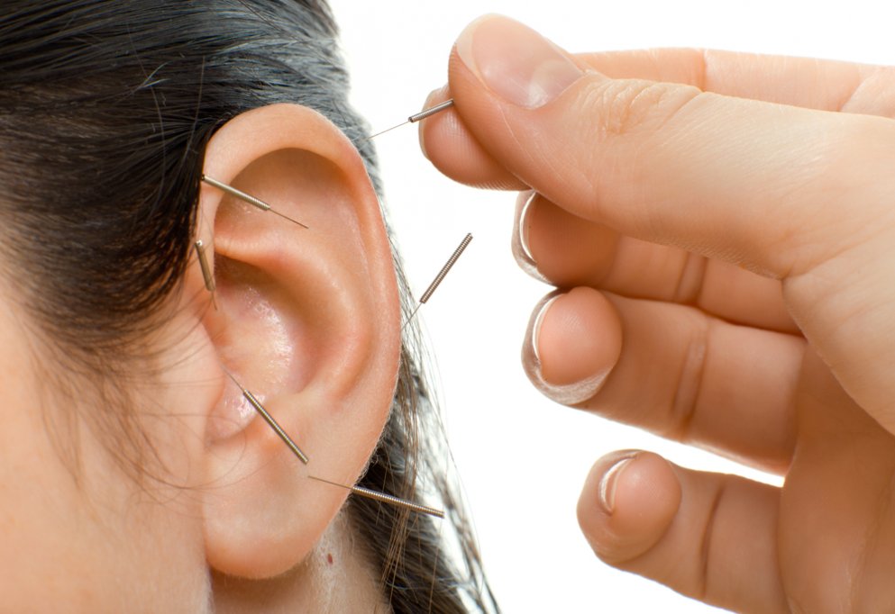 Auriculoterapia - acupunctura urechii