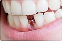 Implantul dentar - 4 mituri despre cea mai populara procedura de inlocuire a dintilor pierduti
