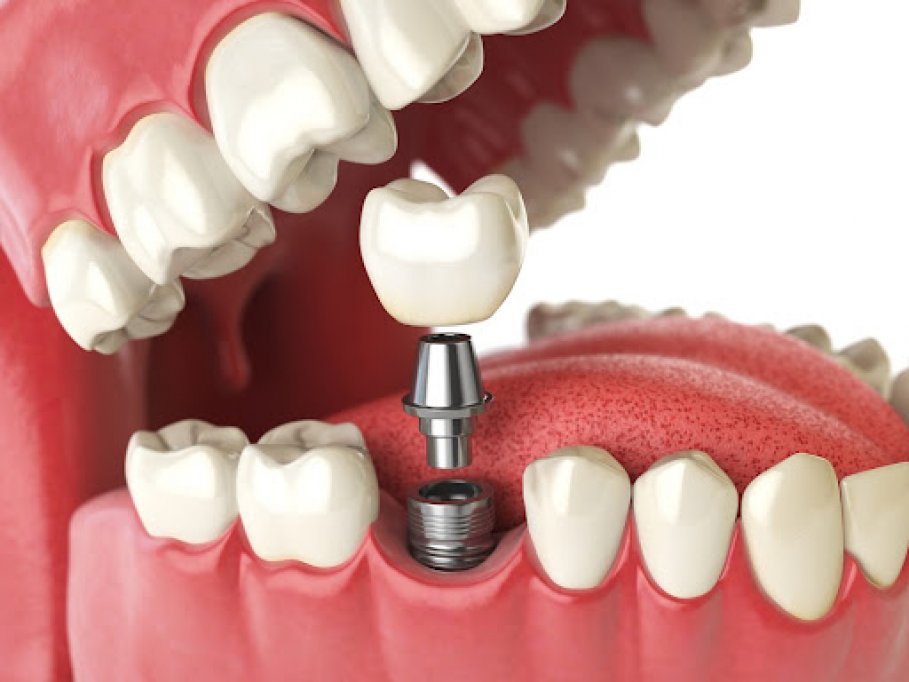 Ce trebuie să știi despre implanturile dentare?