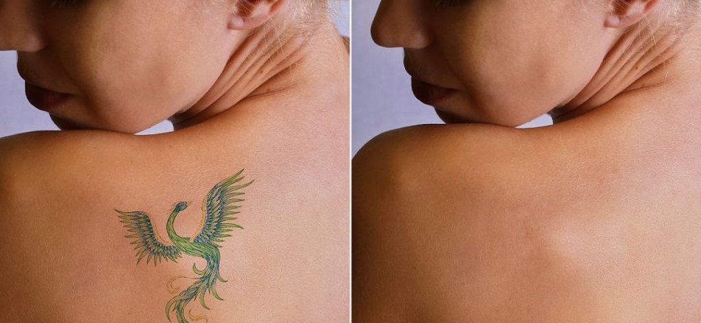 Indepartarea tatuajelor cu laser la Timisoara