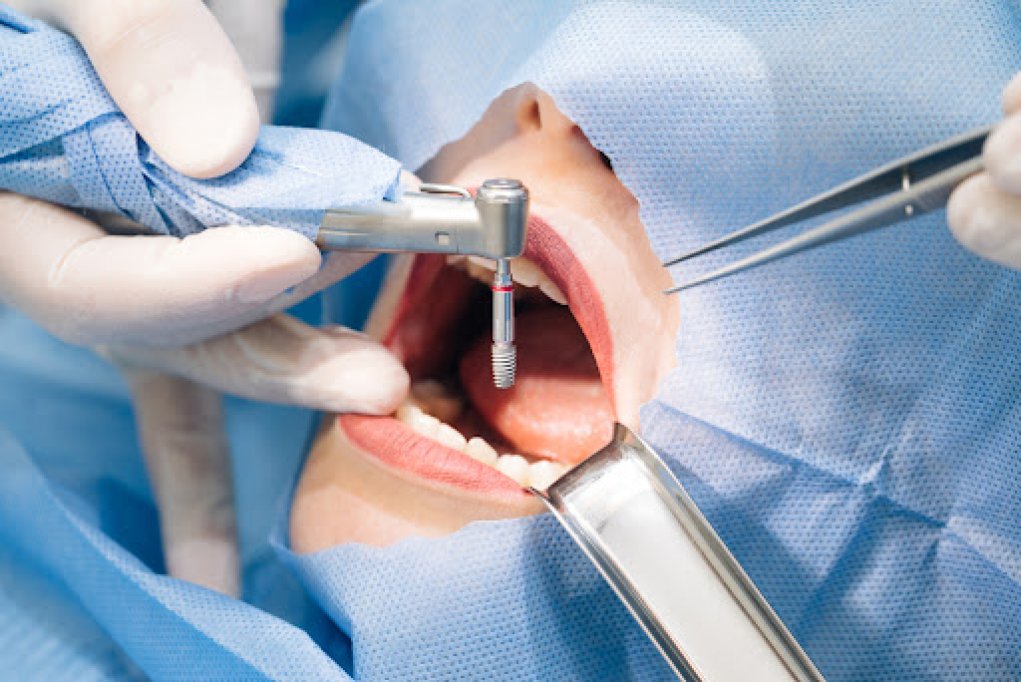 3 tipuri de implanturi dentare și avantajele lor
