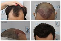 Clinica Dr. Felix Hair Implant te ajută cu un implant de păr reușit